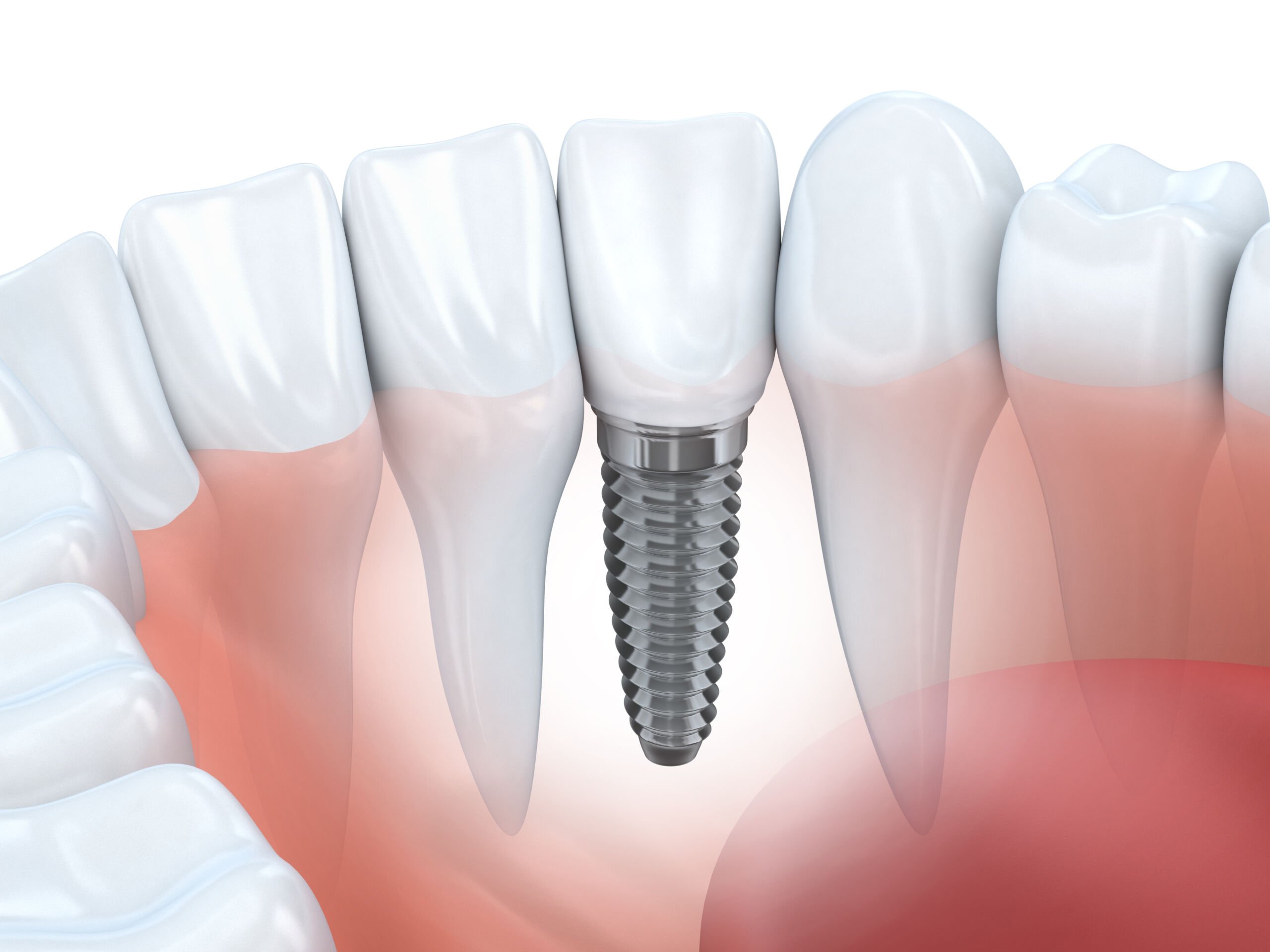 6 Reasons You May Need Dental Implants