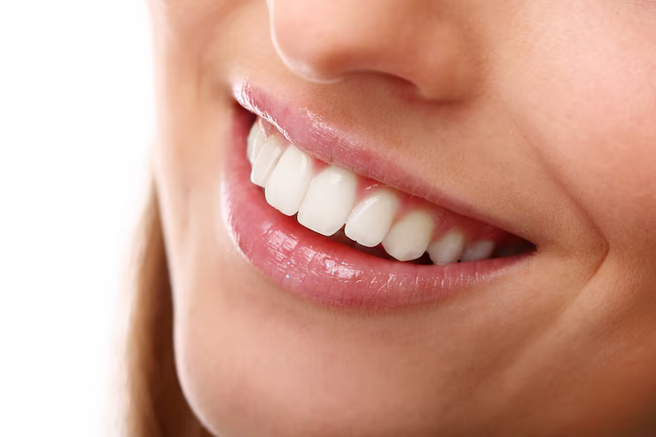 Why Teeth Whitening is best done at the Dentist